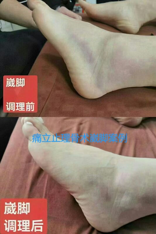 图片[1]-【调理案例】告别习惯性崴脚！痛立止理骨术让你重新"脚踏实地"！