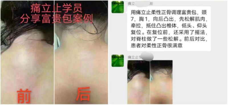 图片[1]-【学员案例】痛立止理骨术调理富贵包效果显著，客户直呼"太神奇了！"