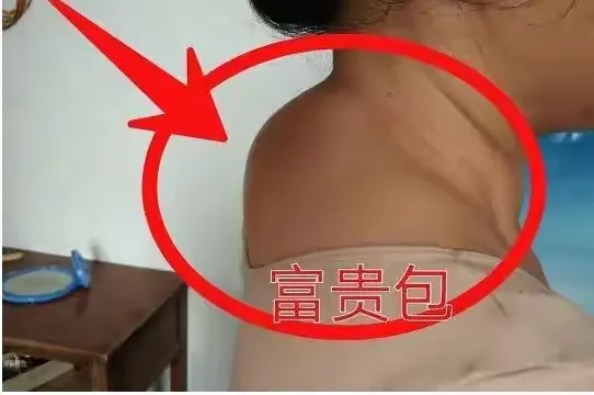 富贵包是怎么形成的？富贵包的调理思路