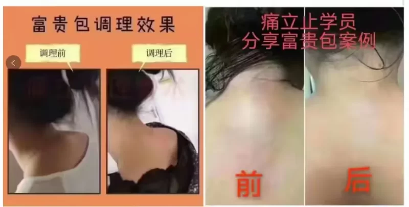 图片[2]-富贵包是怎么形成的？富贵包的调理思路