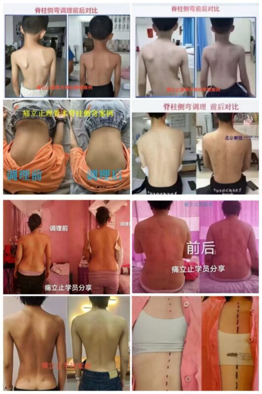 图片[5]-【非遗传承・无痛正骨】痛立止理骨术课程简章：零基础也能学会的柔性正骨技术